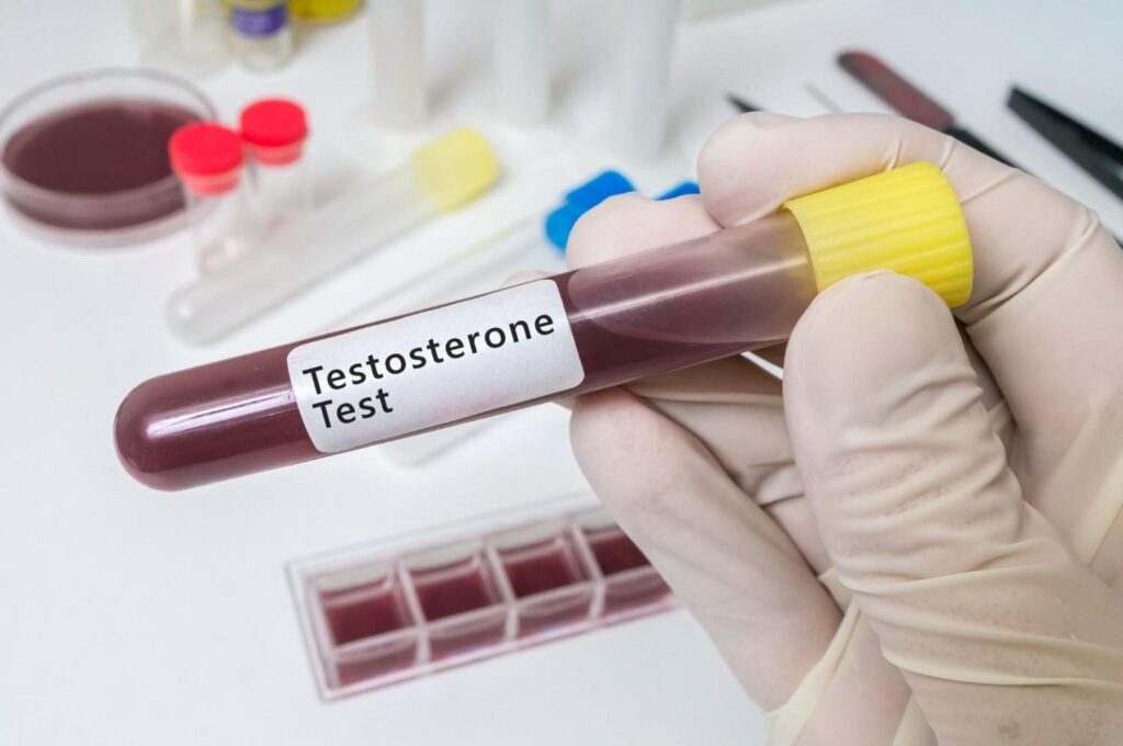 Blood sample being tested to measure testosterone hormone levels